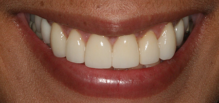 Case seven after smile enhancement
