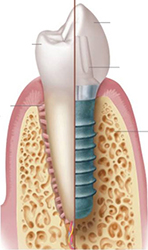 Dental implant illustration