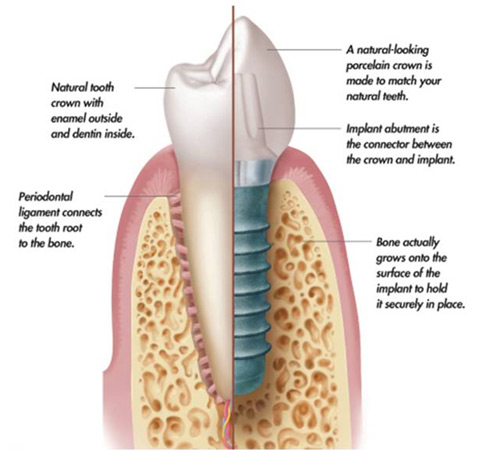 Dental implant chart