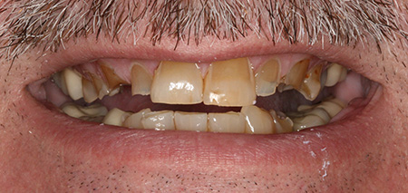 Case Two Before Prosthodontics
