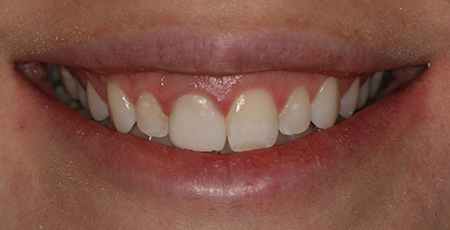 Case One before smile enhancement