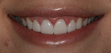 Case One after smile enhancement
