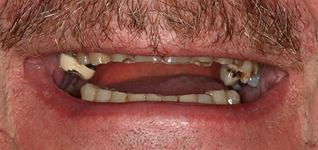 Case One Before Prosthodontics