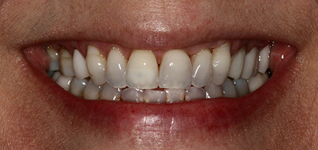 Case Two before smile enhancement
