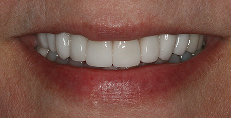Case Two after smile enhancement